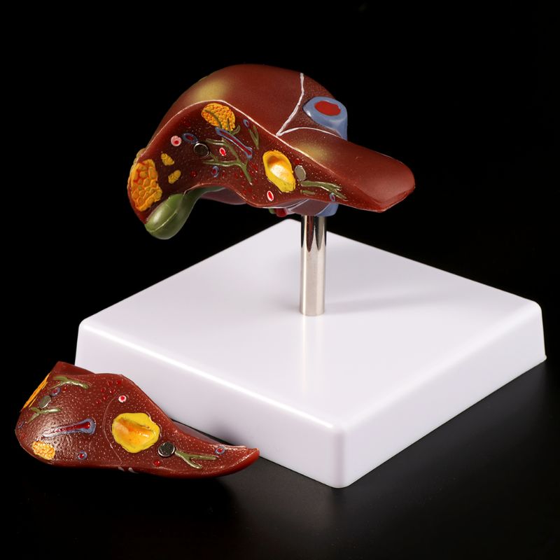 Medical Lab Technology - Insan Karaciğer Patolojik Anatomik Modeli Anatomi